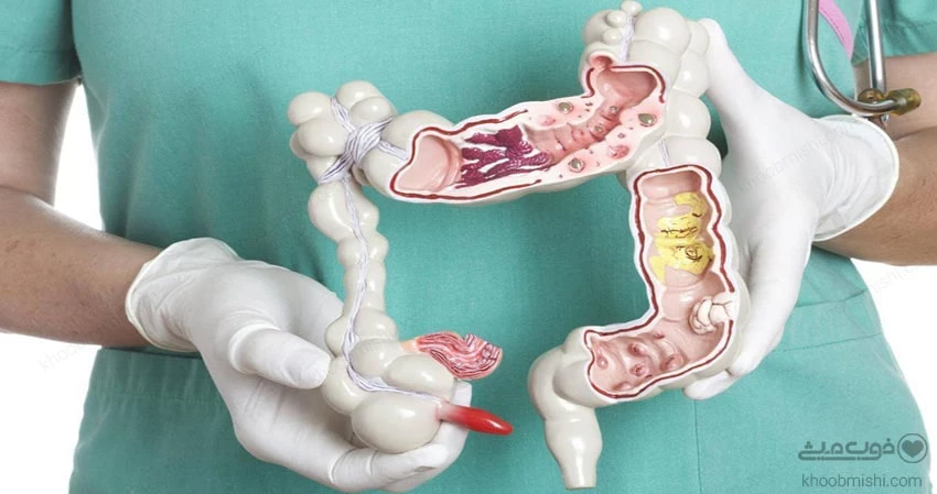 سرطان روده چیست