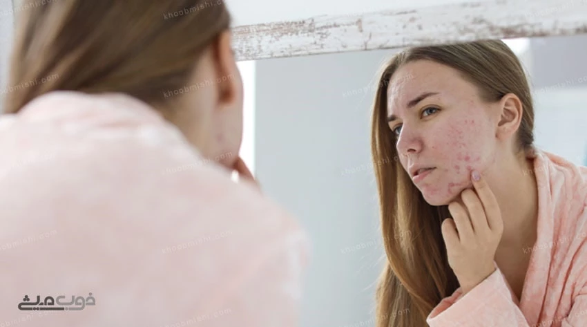 جوش هر نقطه از صورت نشان از چه مشکلی است