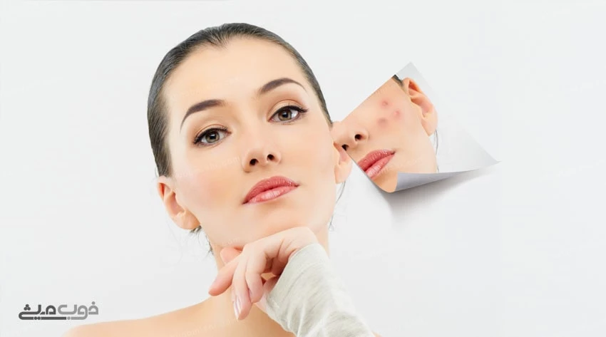 انواع جوش صورت