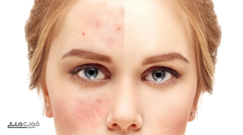 پیشگیری از جوش صورت