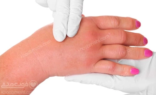 تورم بدن بر اثر مصرف زیاد آب