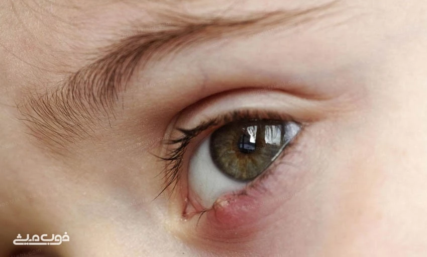 انواع عفونت های چشم