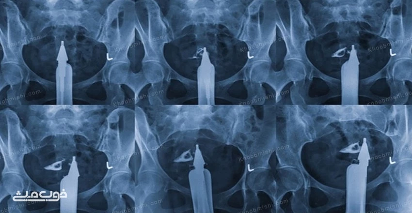 عکس رنگی رحم چه چیزی را نشان میدهد