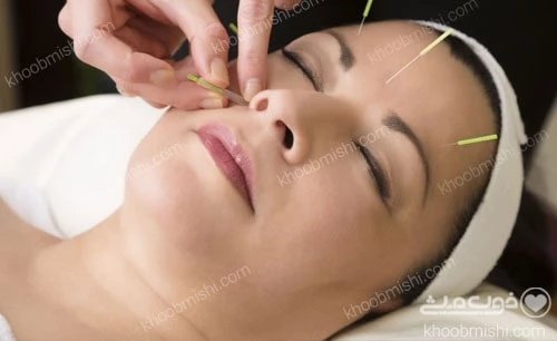 درمان قطعی میگرن با طب سوزنی