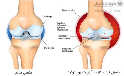بیماری روماتیسم مفصلی (آرتریت روماتوئید) چه تاثیری بر عملکرد مفاصل دارد؟