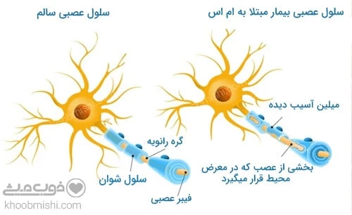 بیماری مالتیپل اسکلروزیس (ام اس)