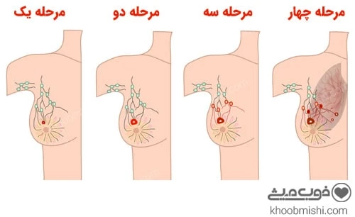 مراحل سرطان