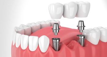 ایمپلنت دندان روشی برای جایگزینی دندان‌های از دست رفته