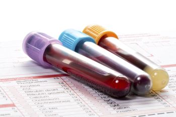هر چند وقت یک بار باید آزمایش خون بدهیم ؟