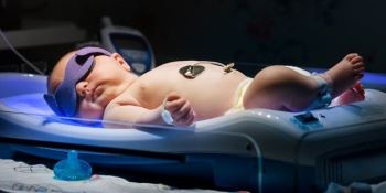 درمان زردی نوزاد با شیر خشک | از شایعه تا واقعیت