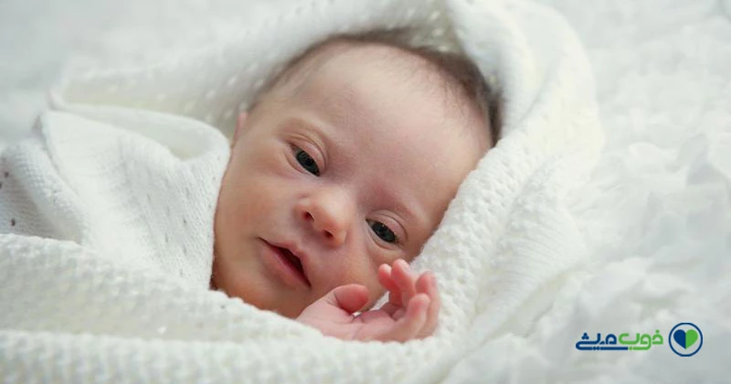 سندرم داون از چند ماهگی قابل تشخیص است