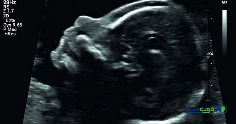 تشخیص سندرم دان در غربالگری