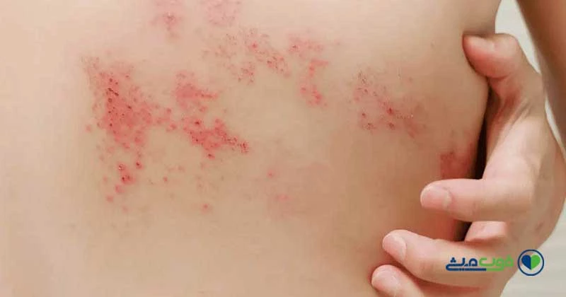 برای بهبود زونا چی بخوریم