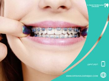 آیا ارتودنسی برگشت دارد؟ + راه های جلوگیری از برگشت ارتودنسی