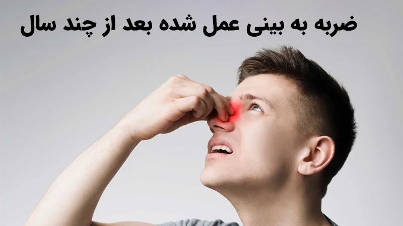 عوارض ضربه به بینی عمل شده بعد از چند سال [اقدامات و راهکارها]