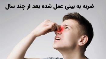 عوارض ضربه به بینی عمل شده بعد از چند سال [اقدامات و راهکارها]