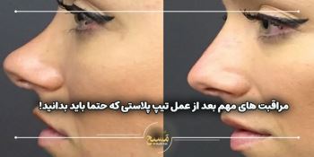 مراقبت های مهم بعد از عمل تیپ پلاستی که حتما باید بدانید