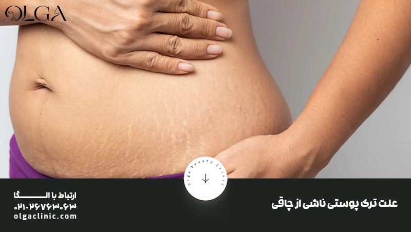تنها و موثرترین راه درمان ترک پوستی ناشی از چاقی