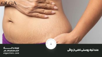 تنها و موثرترین راه درمان ترک پوستی ناشی از چاقی
