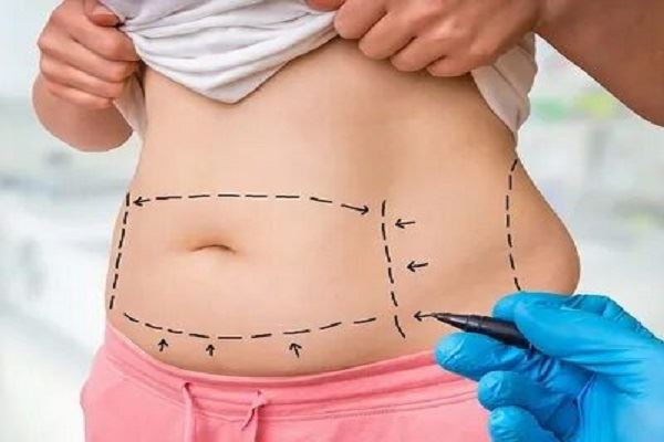 9 روش برای جلوگیری از شلی و افتادگی پوست بعد از لیپوماتیک