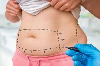 9 روش برای جلوگیری از شلی و افتادگی پوست بعد از لیپوماتیک