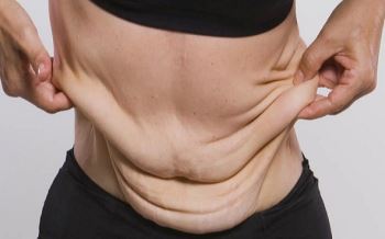9 روش برای جلوگیری از شلی و افتادگی پوست بعد از لیپوماتیک