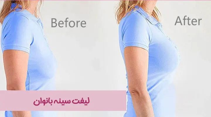 آیا شما کاندید مناسبی برای لیفت سینه هستید؟