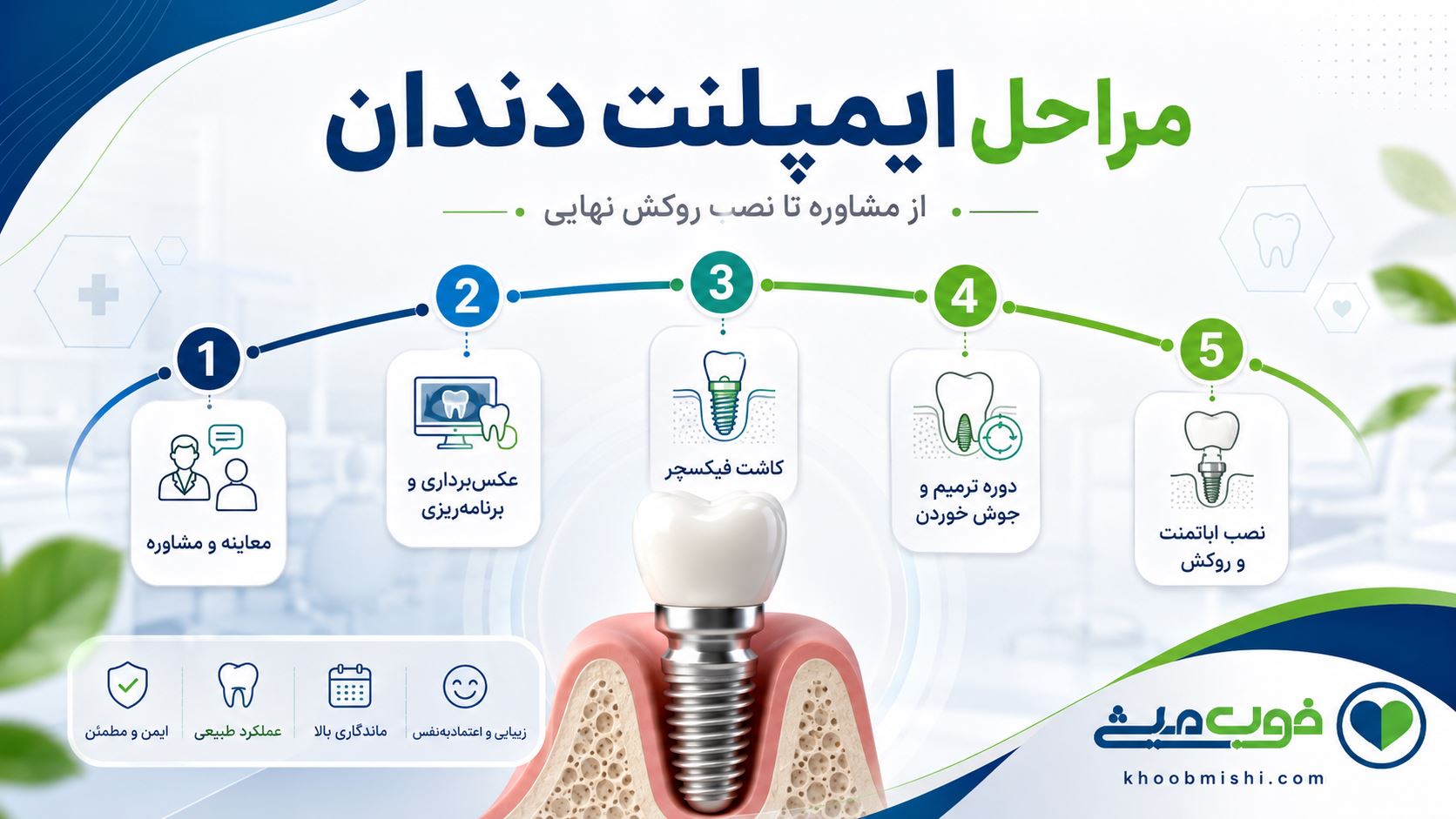 مراحل ایمپلنت دندان