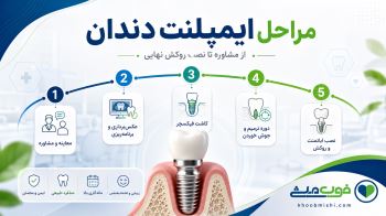 مراحل ایمپلنت دندان