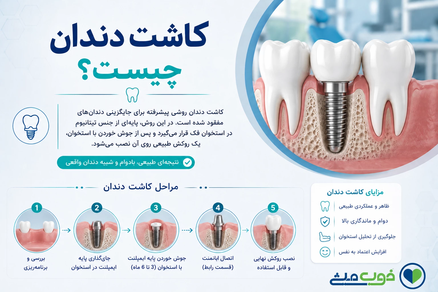 کاشت دندان چیست؟