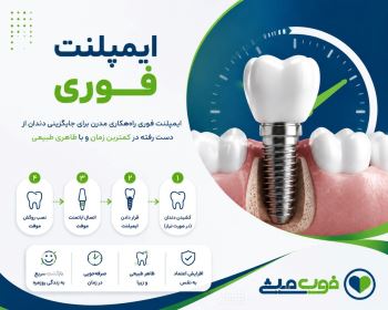 ایمپلنت فوری 