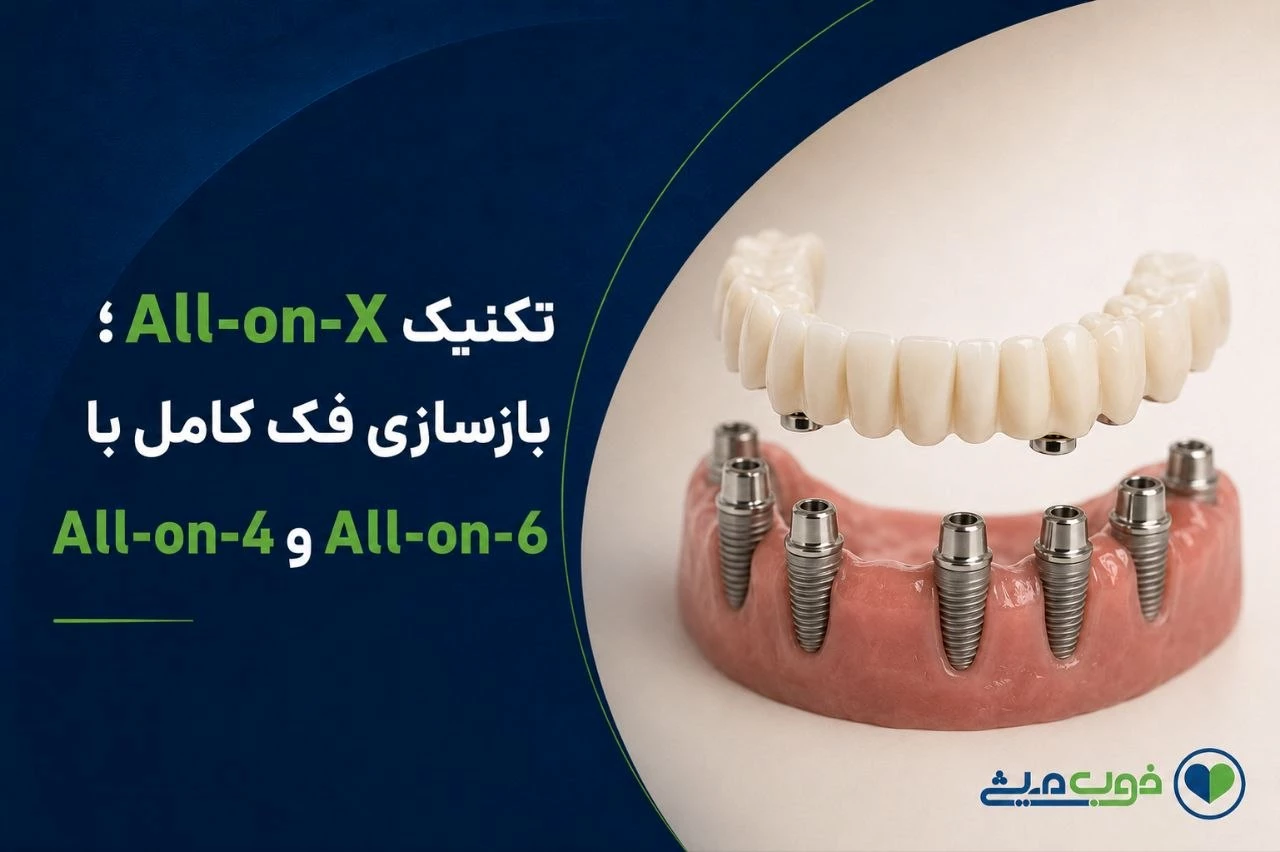 تکنیک All-on-X؛ بازسازی فک کامل با All-on-4 و All-on-6