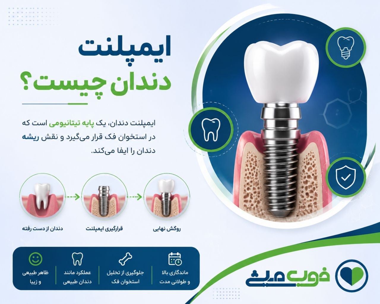 ایمپلنت دندان چیست؟