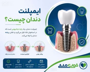 ایمپلنت دندان چیست؟