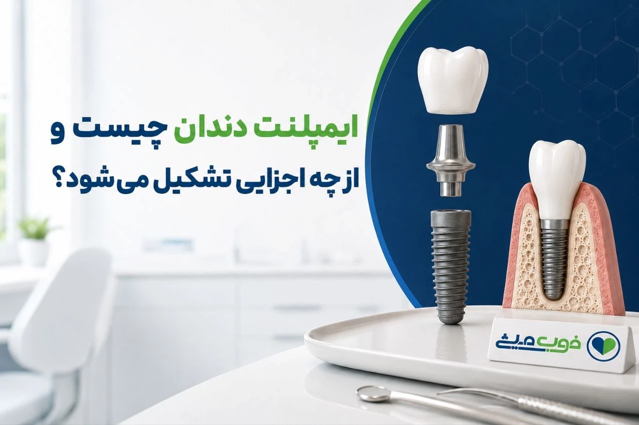 ایمپلنت دندان چیست و از چه اجزایی تشکیل میشود؟