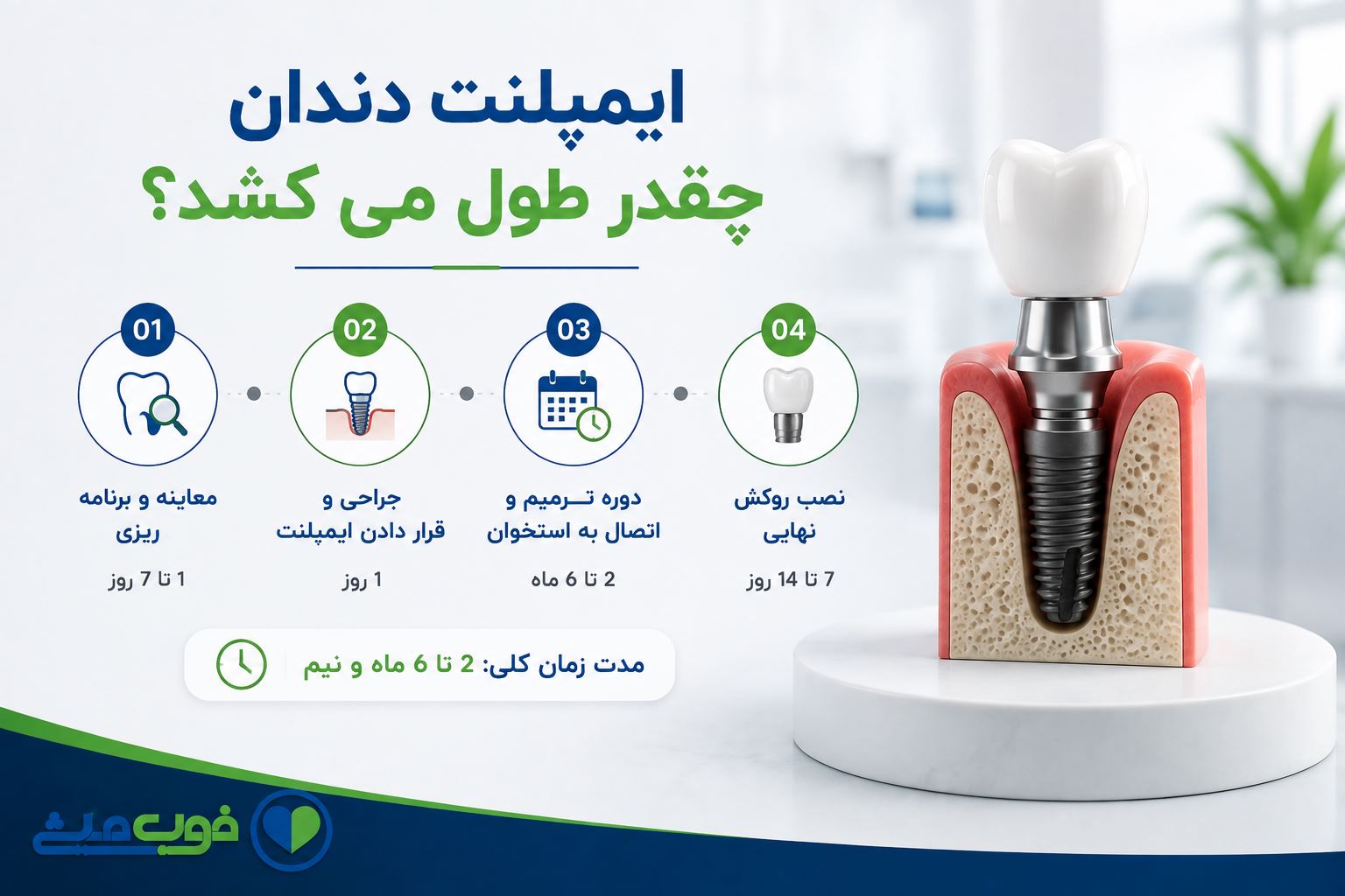 ایمپلنت دندان چقدر طول می کشد؟