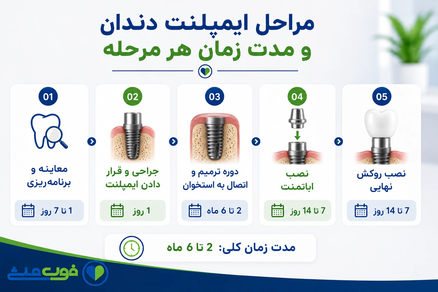 مراحل ایمپلنت دندان و مدت زمان هر مرحله