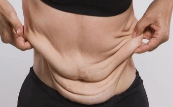 9 روش برای جلوگیری از شلی و افتادگی پوست بعد از لیپوماتیک