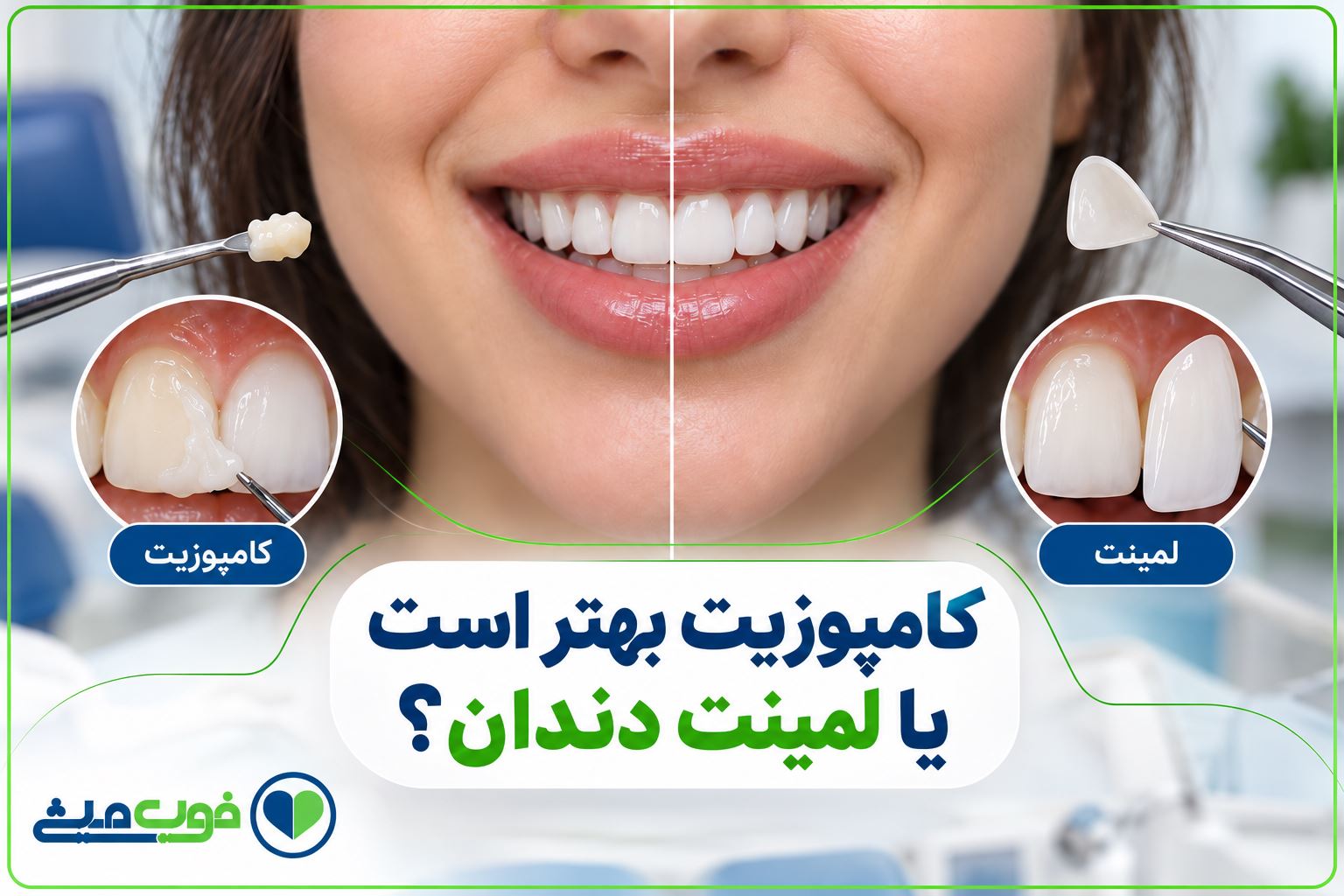 کامپوزیت بهتر است یا لمینت دندان؟