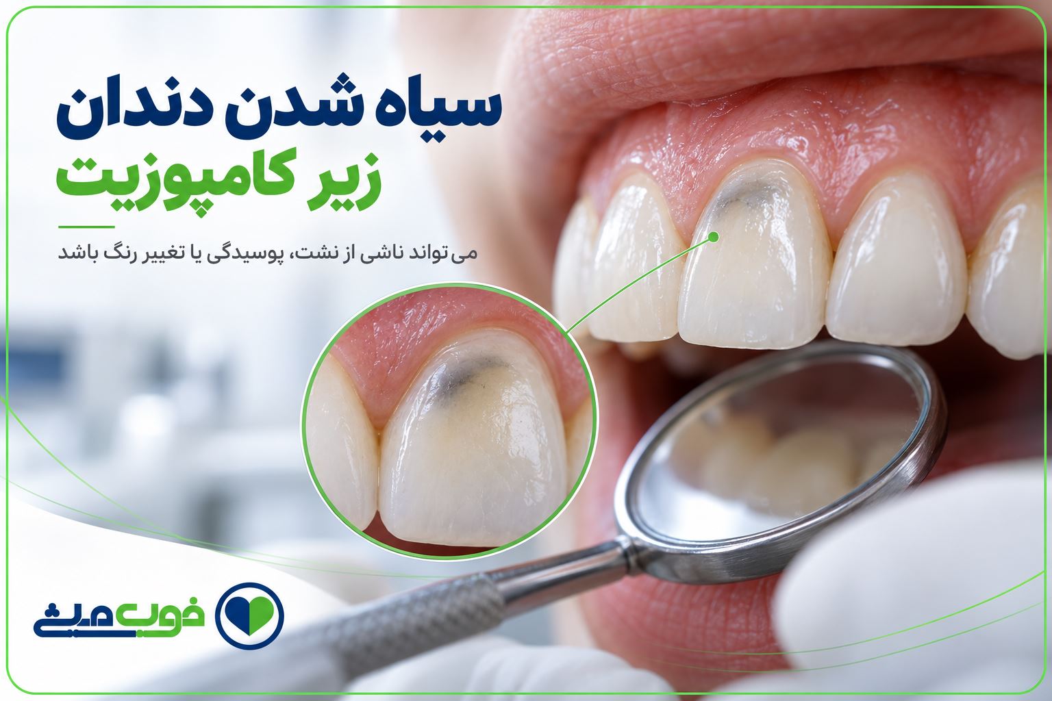 سیاه شدن دندان زیر کامپوزیت