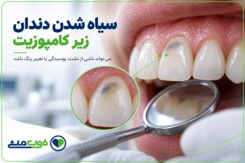 سیاه شدن دندان زیر کامپوزیت