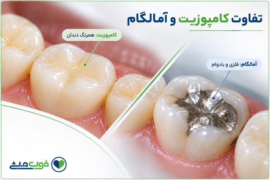 تفاوت کامپوزیت و آمالگام؛ کدام برای ترمیم دندان بهتر است؟