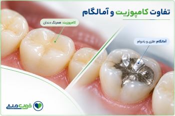 تفاوت کامپوزیت و آمالگام؛ کدام برای ترمیم دندان بهتر است؟